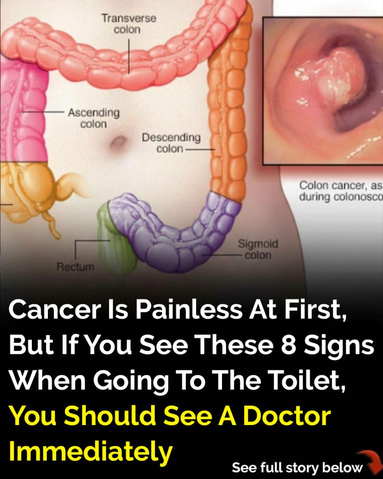 How your bowel movements can signal colon cancer