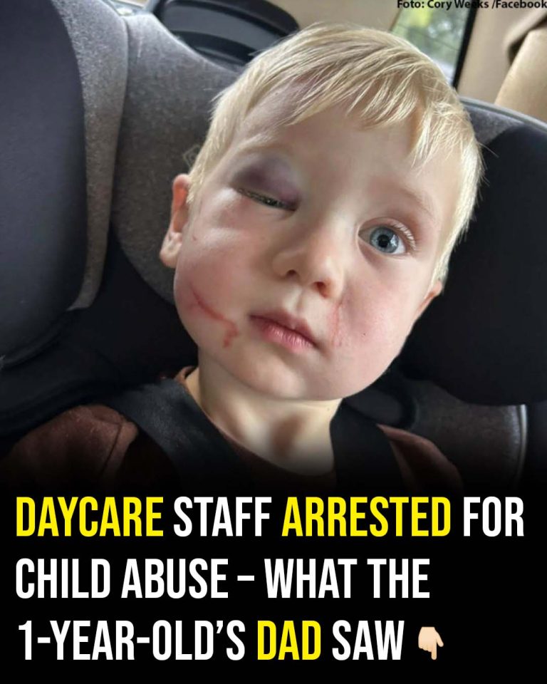 Daycare worker arrested after toddler arrives with black eye and swollen face on first day