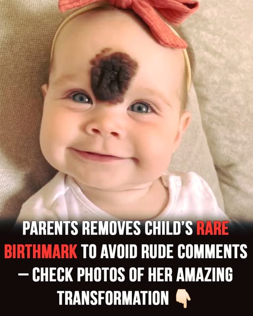 Cruel Comments About Baby’s Rare Birthmark Leave Parents Heartbroken