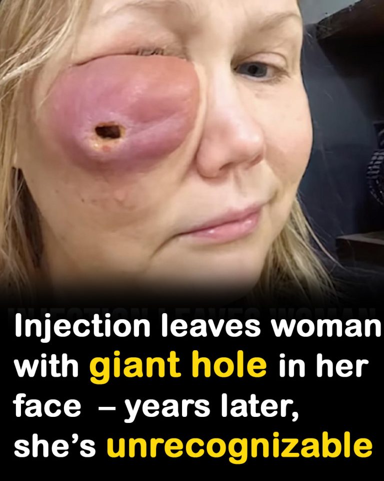Gina Anderson was left with a big hole in her face after filler failure – this is her today, 6 years later